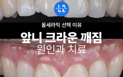 앞니 크라운 깨짐 원인과 치료, 올세라믹 선택 이유