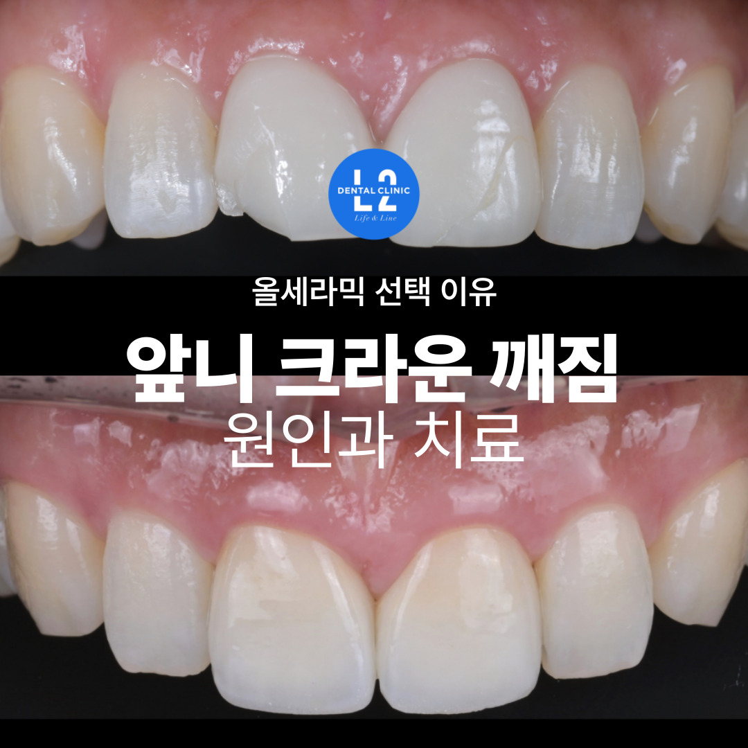 앞니 크라운 깨짐 치료 전후 비교 이미지 – 치아파절 및 올세라믹 크라운 치료 사례