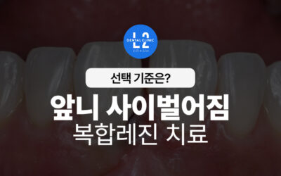 앞니 사이벌어짐 복합레진 치료, 교정 없이 대칭 회복하는 법