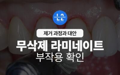 무삭제 라미네이트 부작용, 제거 과정과 대안