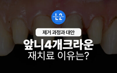 앞니4개크라운 재치료, 왜 고려해야 할까?