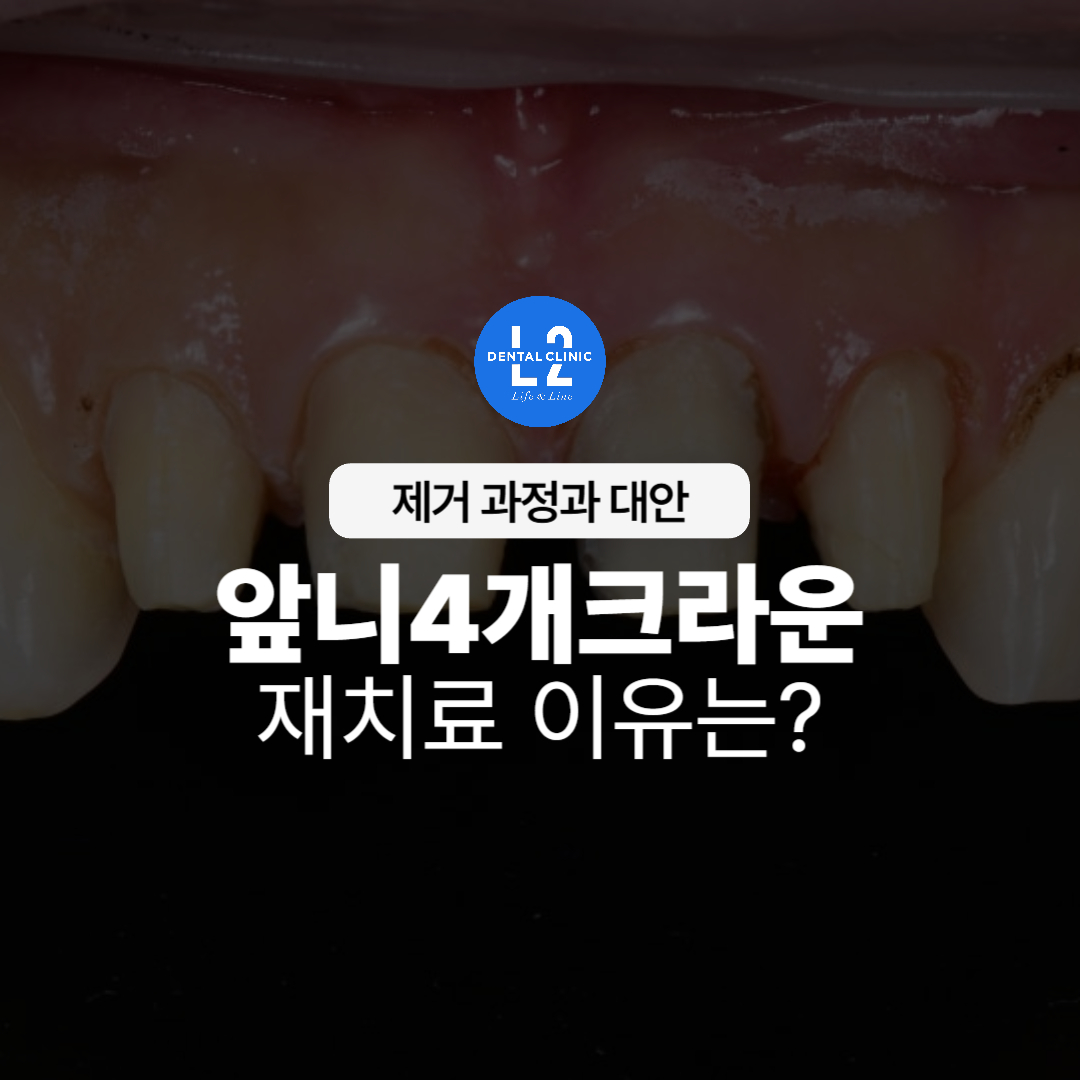 앞니 크라운 제거 상태 모습