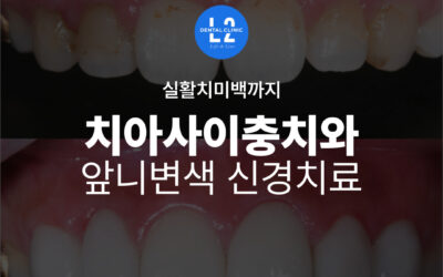 치아사이충치와 앞니변색, 신경치료부터 실활치미백까지