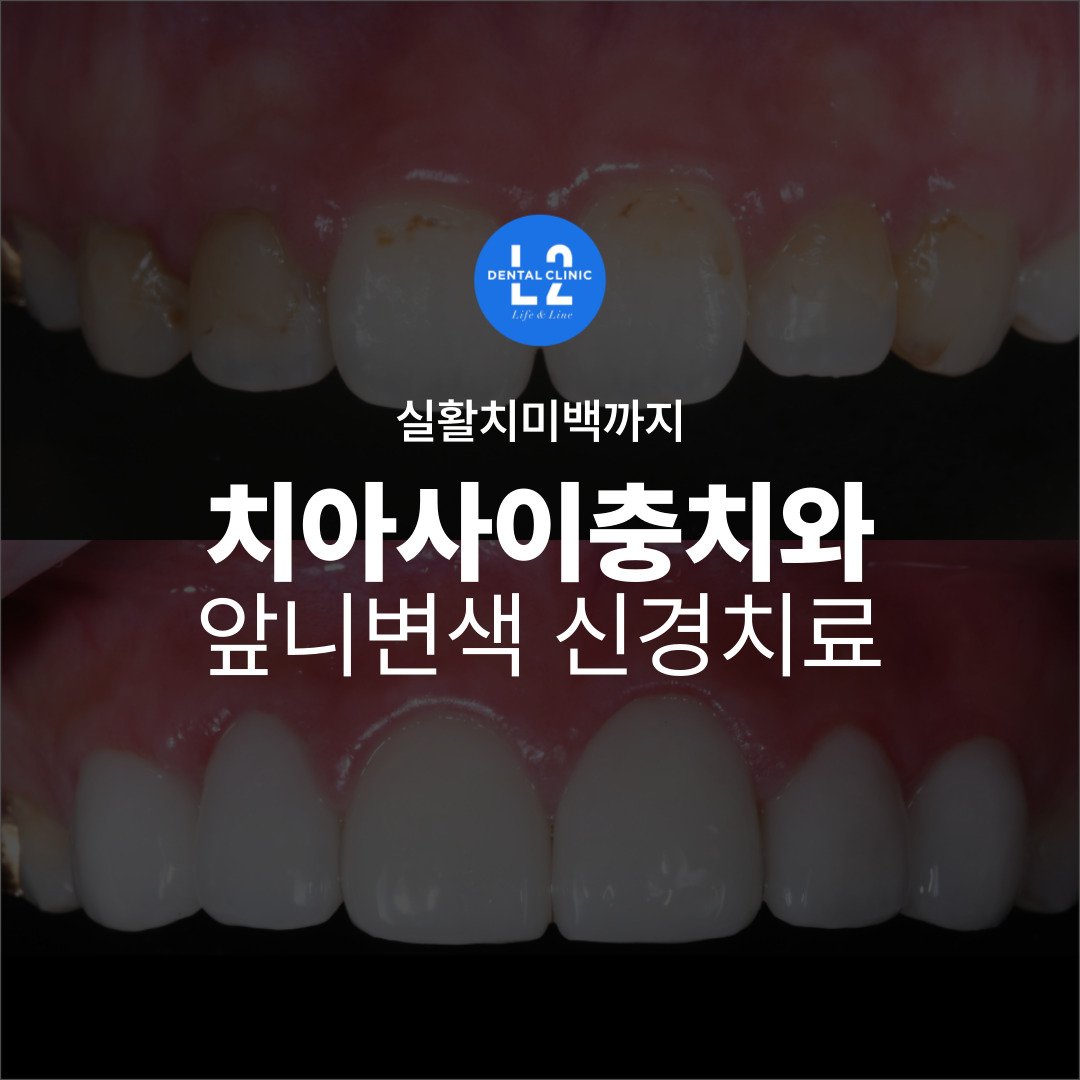 치아사이충치와 앞니변색, 신경치료 및 실활치미백 전후 비교 이미지