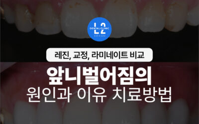 앞니벌어짐의 원인과 이유 치료방법 – 레진, 교정, 라미네이트 비교