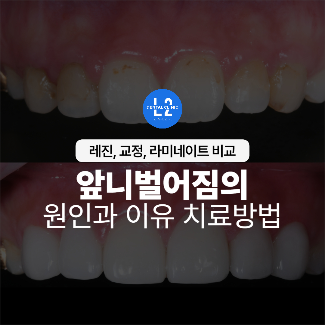 앞니벌어짐의 원인과 치료방법을 설명하는 타이틀 이미지
