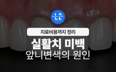실활치 미백, 앞니변색의 원인과 치료비용까지 정리