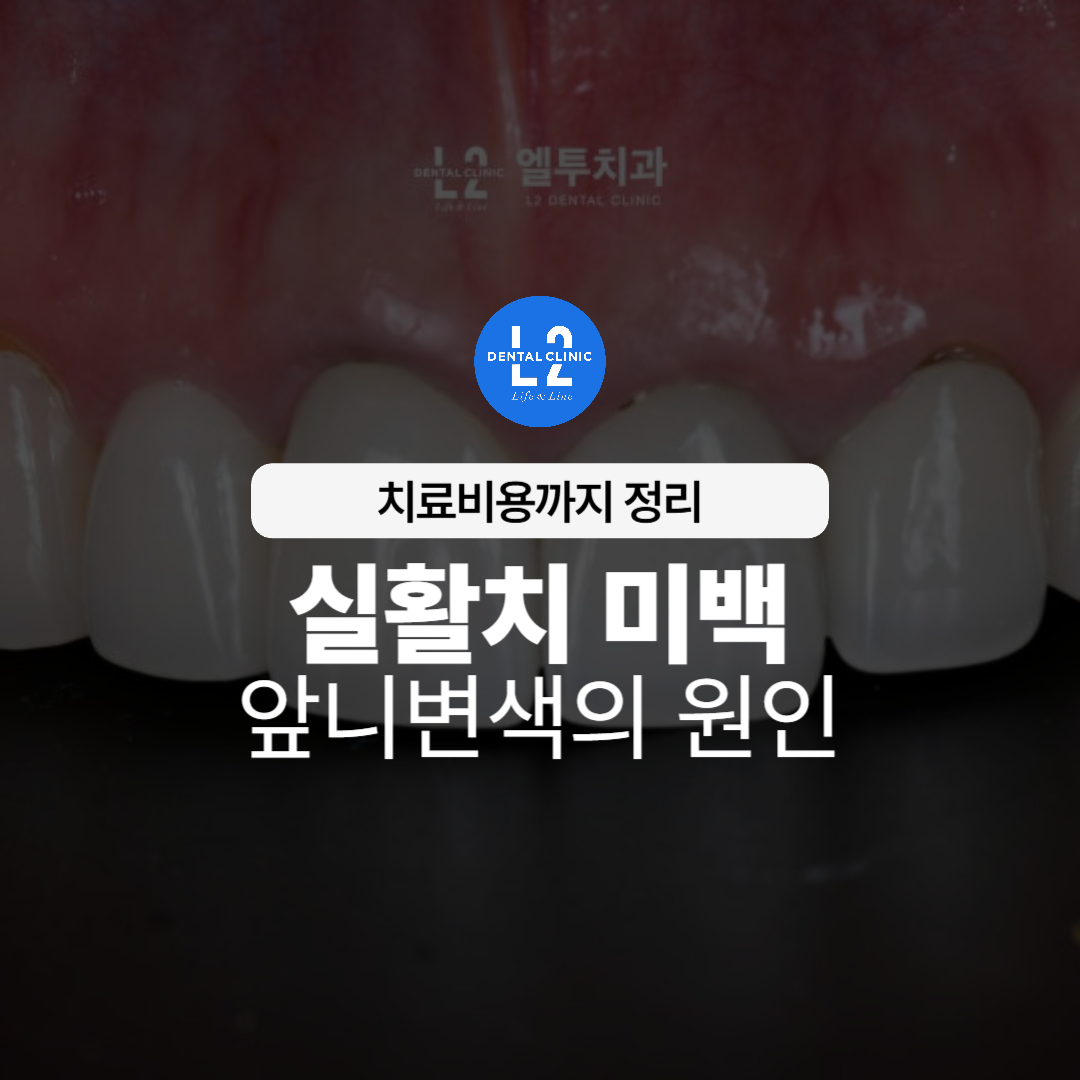 실활치 미백과 앞니 변색 원인을 설명하는 대표 이미지