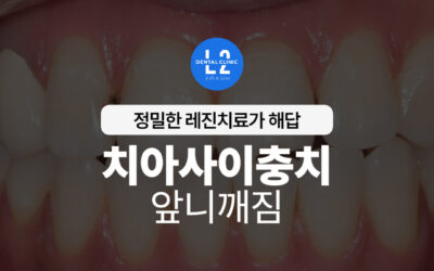 치아사이충치와 앞니깨짐, 정밀한 레진치료가 해답입니다