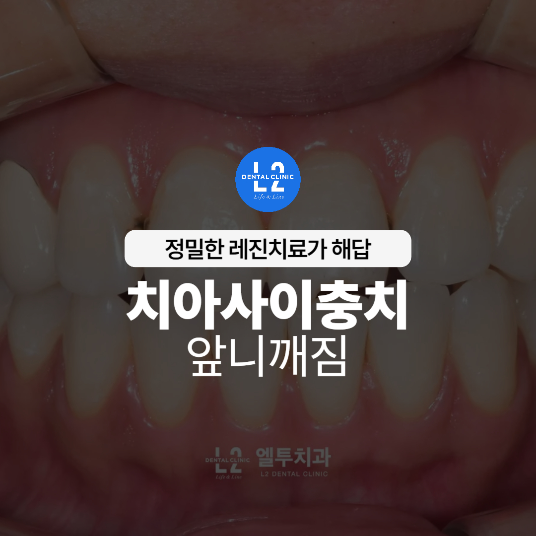 치아사이충치와 앞니깨짐을 강조하는 레진치료 안내 타이틀 이미지
