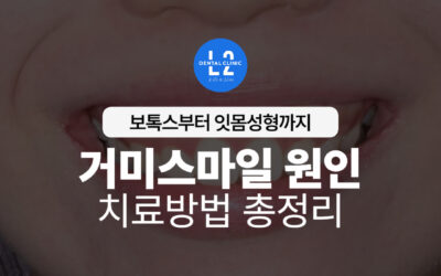 거미스마일 원인 치료방법 총정리 – 보톡스부터 잇몸성형까지