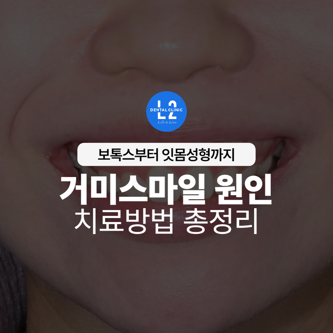 웃을 때 잇몸이 과도하게 드러나는 거미스마일 환자 전면 미소 사진