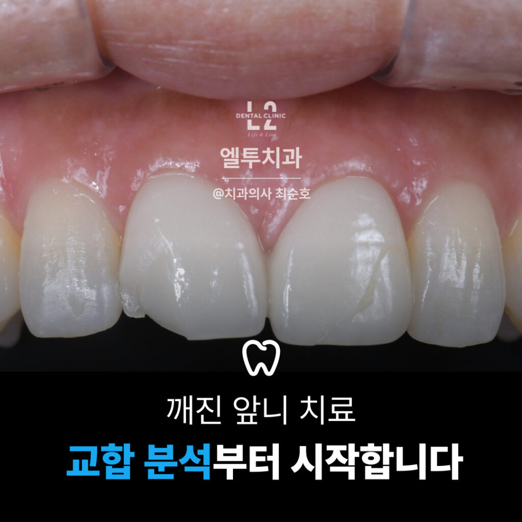 깨진 앞니 크라운 교합 분석 과정 – 턱의 움직임에 따른 접촉 관계를 확인하는 임상 사진