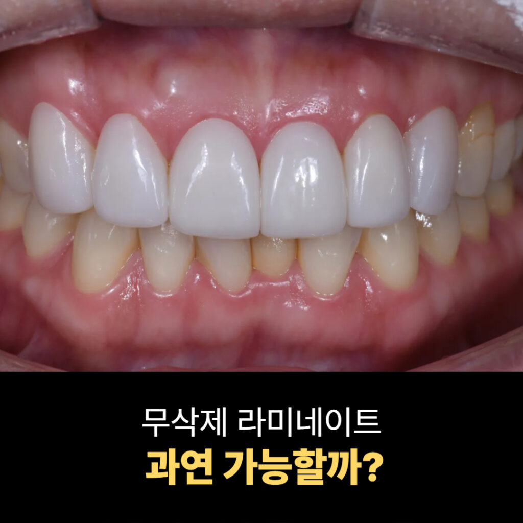 무삭제 라미네이트 시술 후 전치부 모습