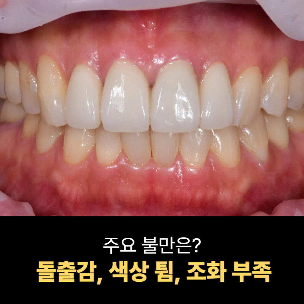 돌출감과 색상 차이가 있는 앞니 크라운 모습