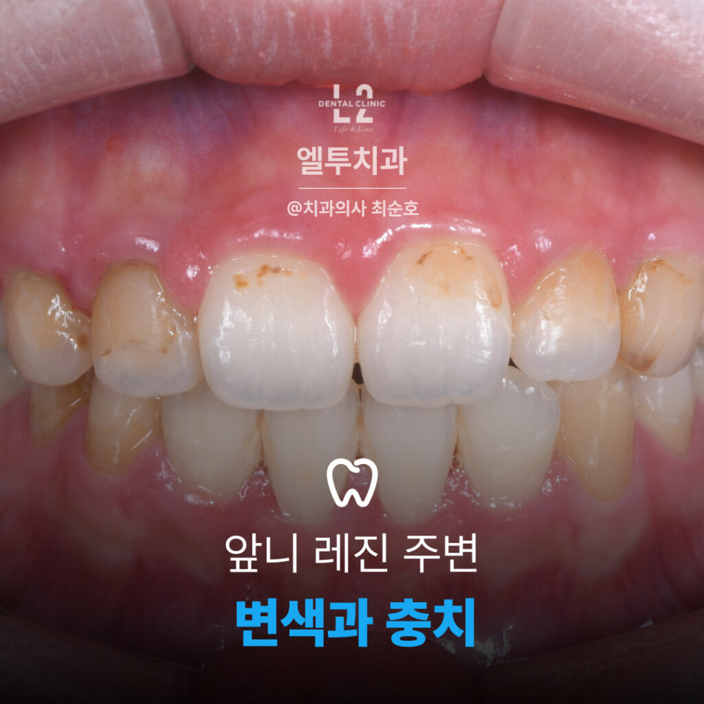 앞니 레진 주변의 변색과 이차충치가 진행된 초기 상태 이미지