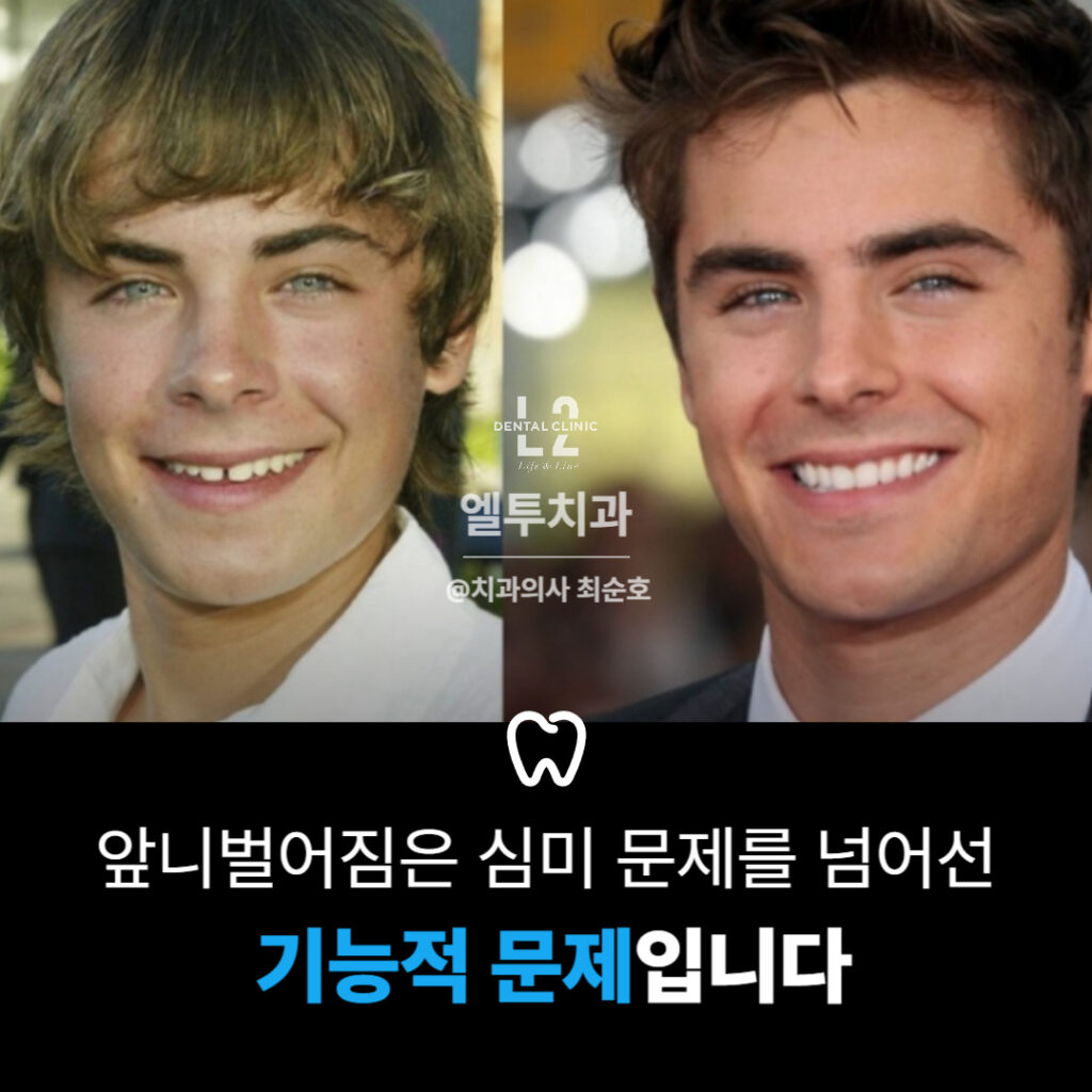 앞니 심미 개선이 얼굴 인상에 끼치는 영향을 보여주는 이미지