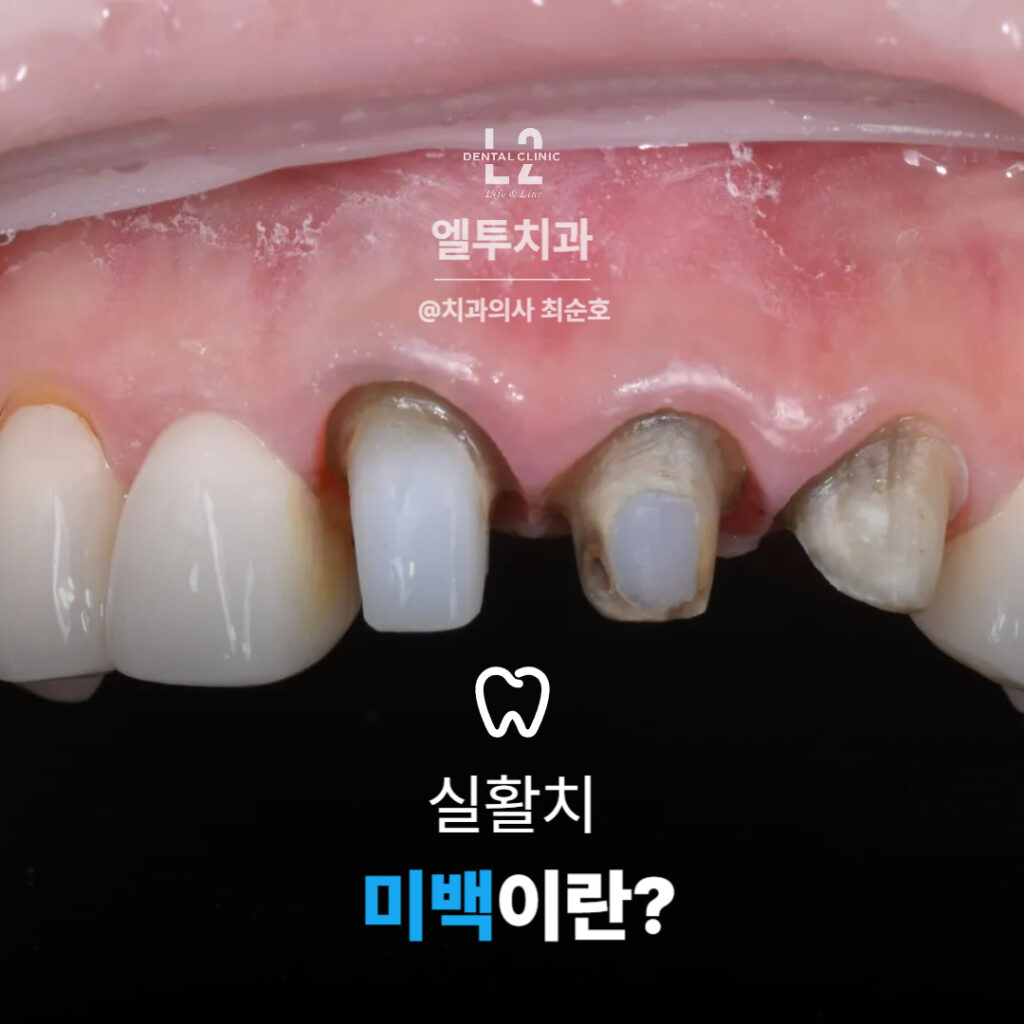 실활치 미백 개념과 신경치료 치아의 색상 변화를 설명하는 이미지