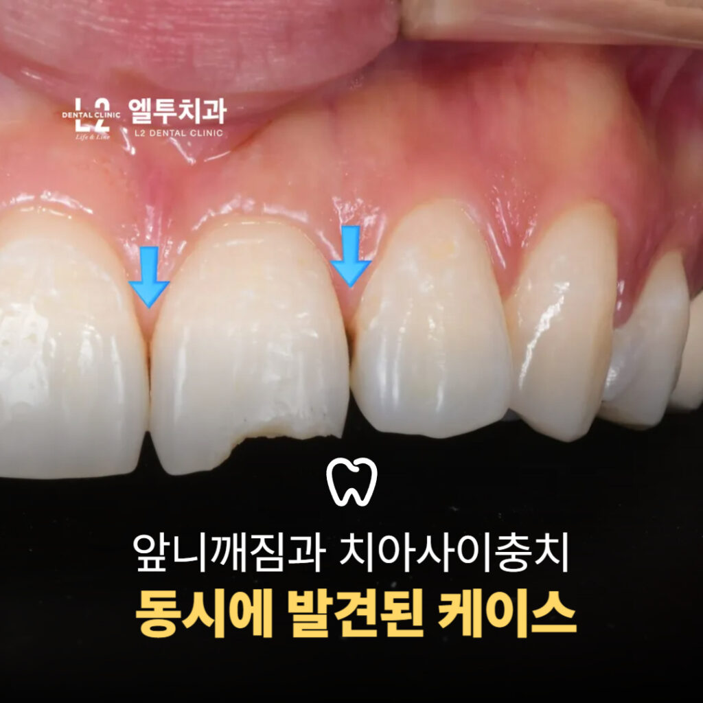 앞니가 깨지고 치아 사이에 충치가 생긴 상태를 보여주는 임상 사진