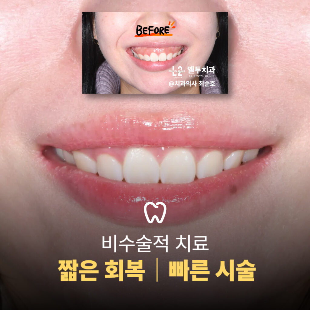 거미스마일 비포 애프터 이미지, 아래는 시술 후 개선된 미소