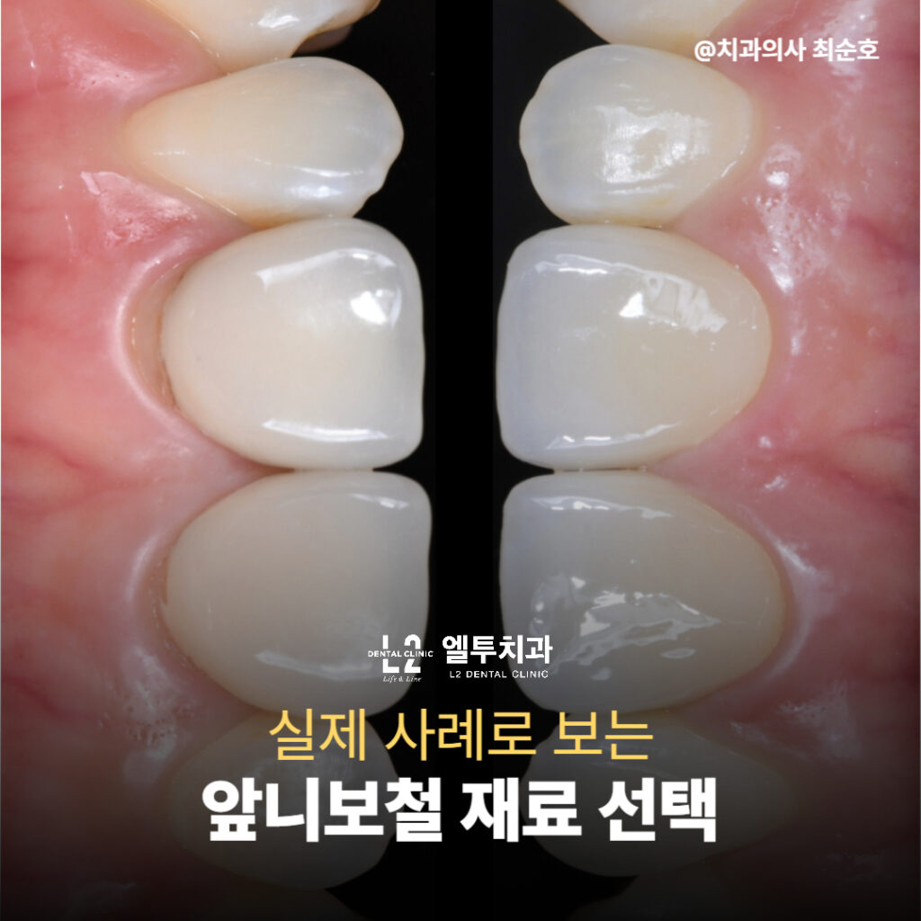 위아래 치아의 재료 차이를 보여주는 근접 이미지, 앞니보철 재료 비교