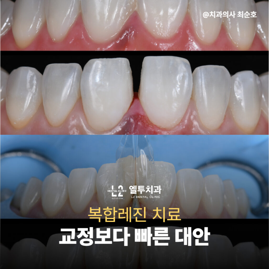 "앞니 사이 벌어진 틈을 복합레진으로 메운 치료 전후 비교 이미지"