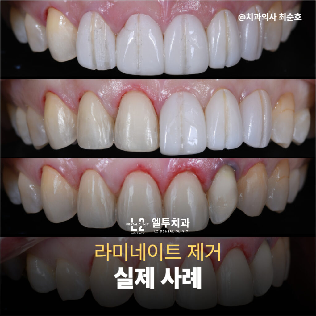 라미네이트 제거 전후 비교 이미지 4단 구성
