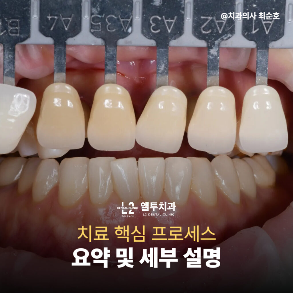 치아 색상 매칭을 위한 셰이드 가이드 비교