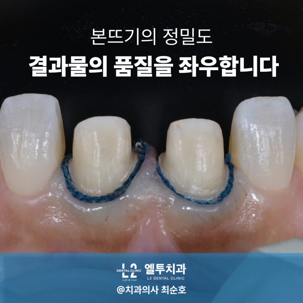 앞니 크라운 치료를 위한 정밀 본뜨기 과정 – 치은압배코드 삽입과 경계 노출 장면