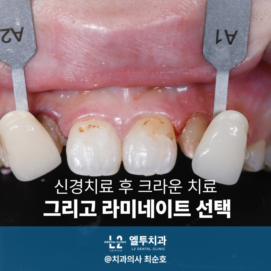 앞니 변색된 치아와 라미네이트 적용 전 대비 이미지