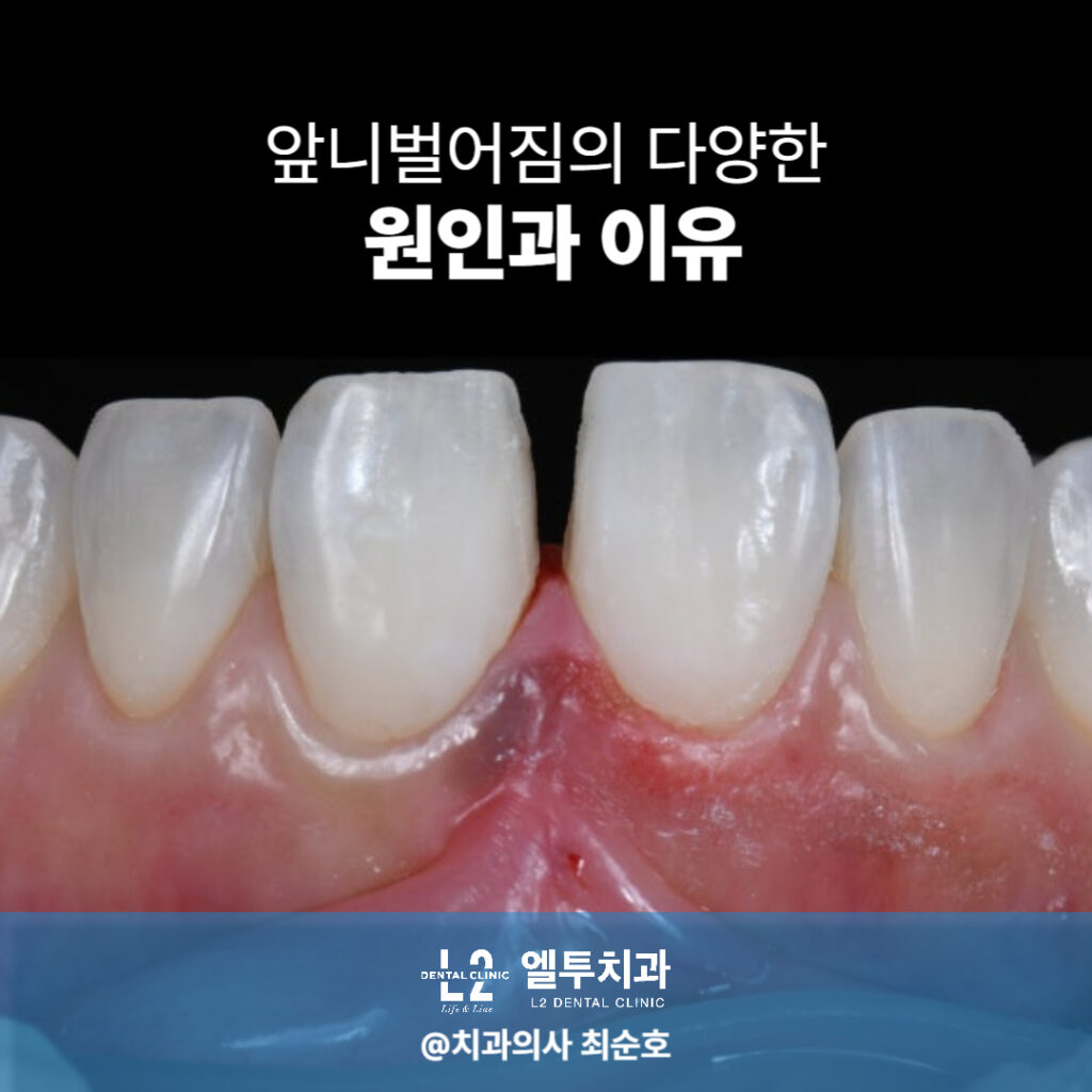 앞니가 벌어진 치아 상태와 그 원인을 설명하는 이미지