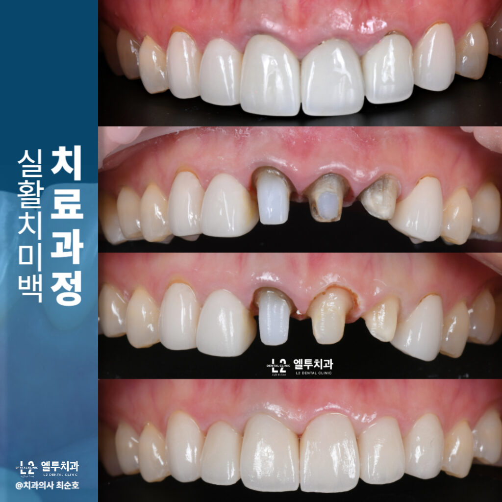 실활치 미백 치료 과정을 4단계 이미지로 나눈 설명 이미지