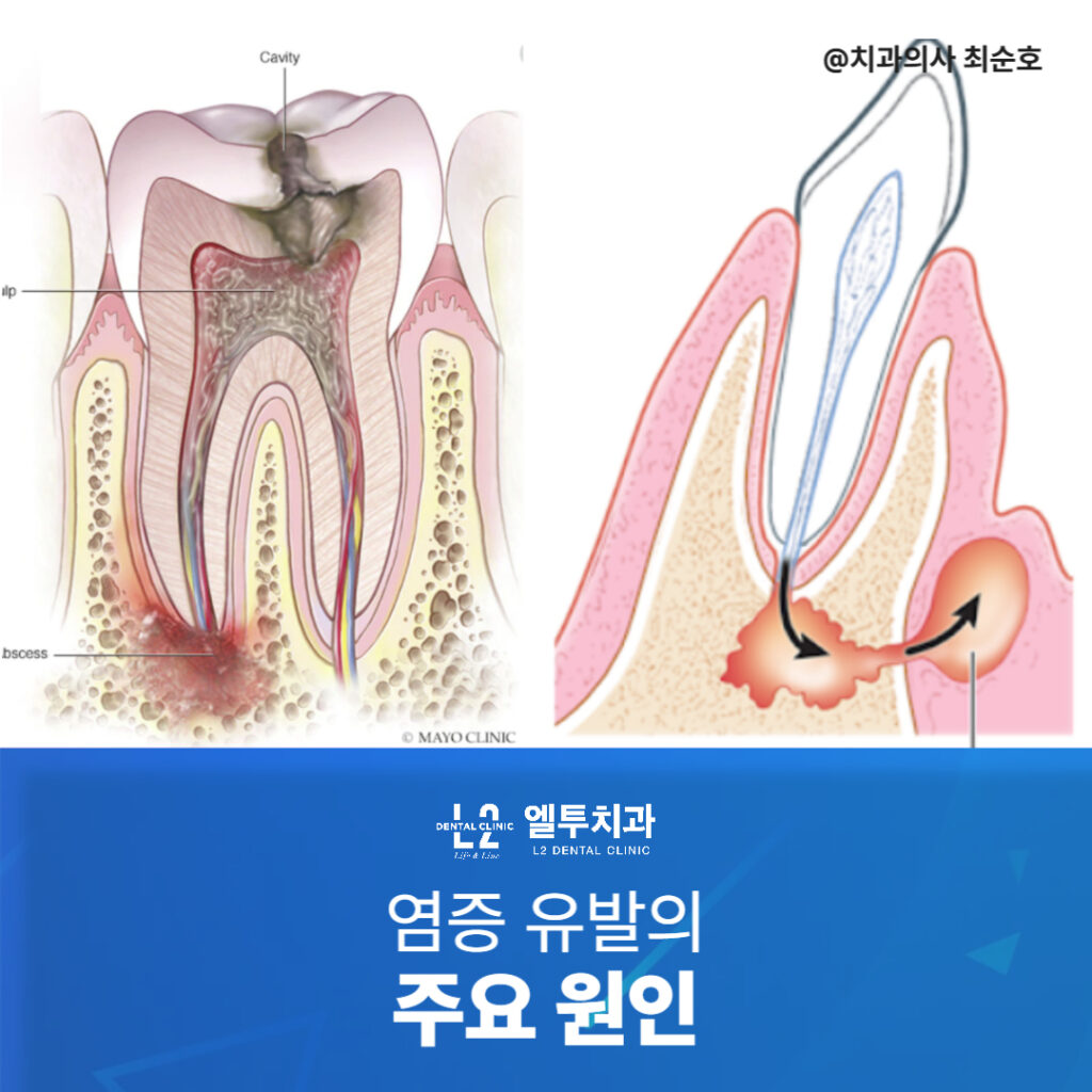 치아 내부 염증 유발 요인을 해부학적으로 설명한 이미지