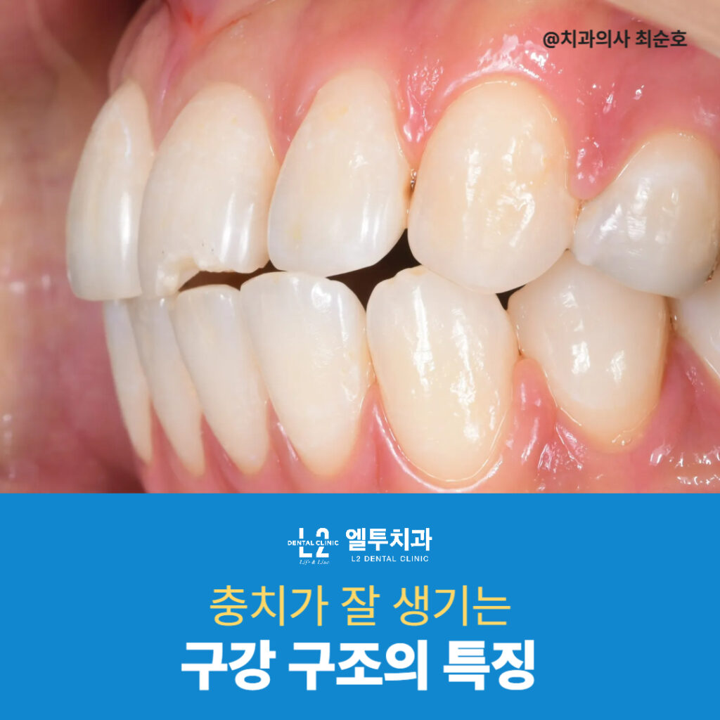 충치에 취약한 구강 구조를 측면에서 보여주는 임상 사진