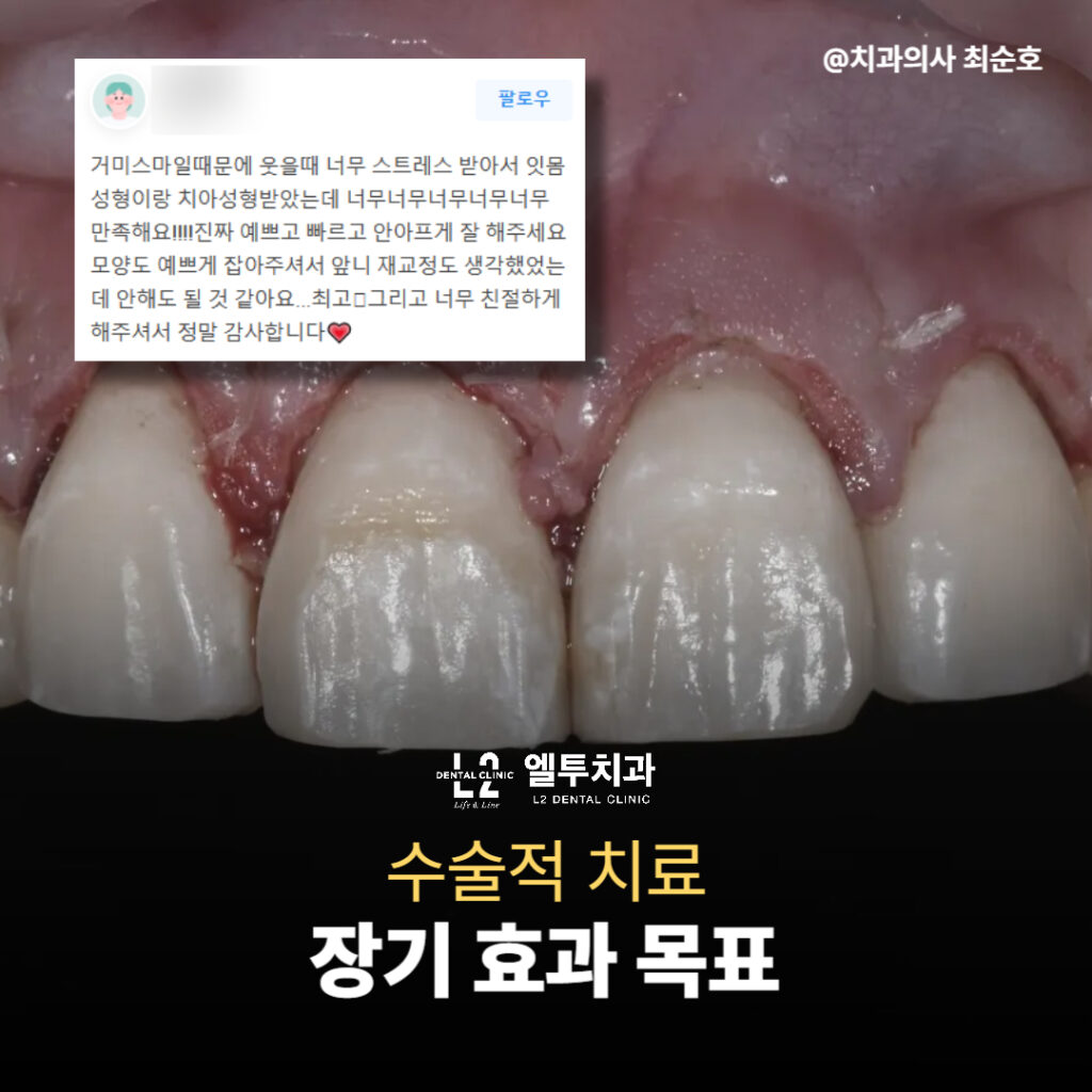거미스마일 수술 후 잇몸선이 정돈된 환자 치아 사진
