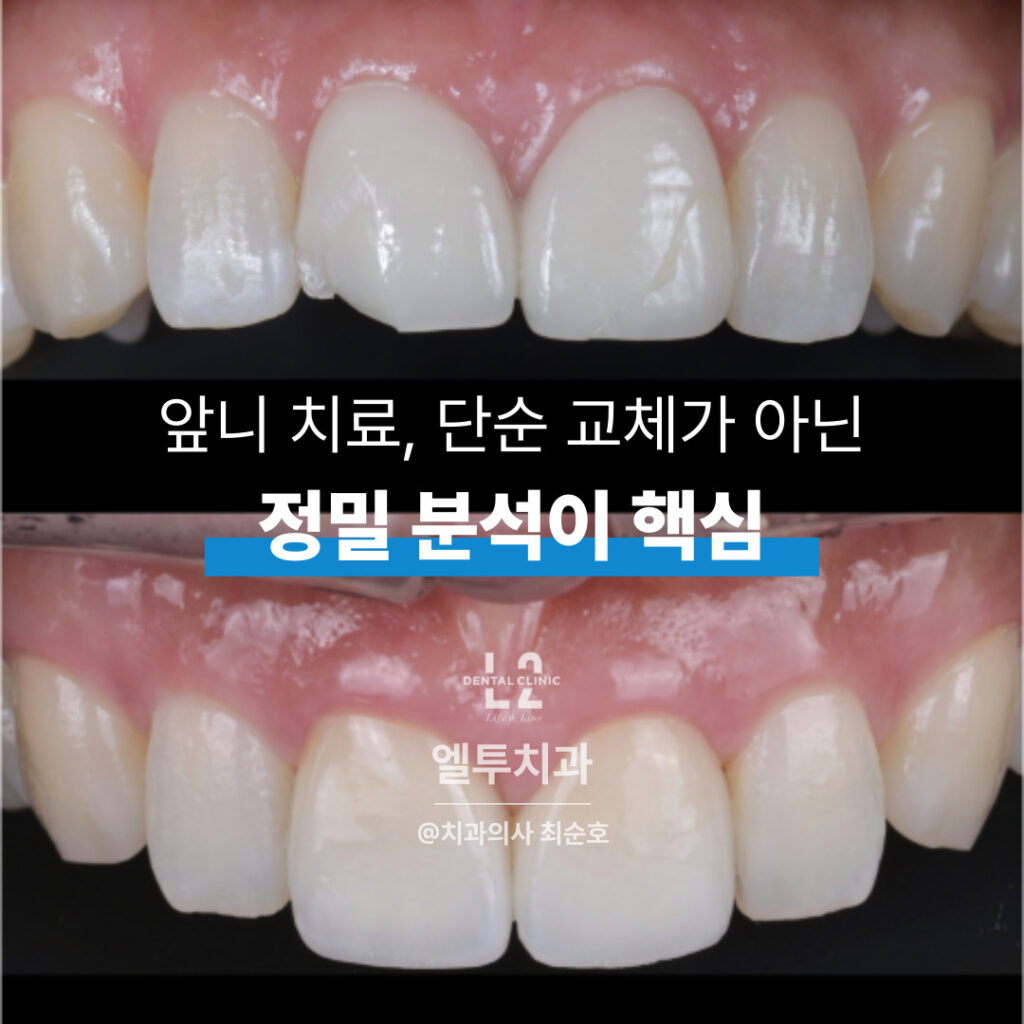 앞니 크라운 재치료 후 완성된 심미보철 결과 – 정밀 분석과 기공 과정을 거친 치료 사례