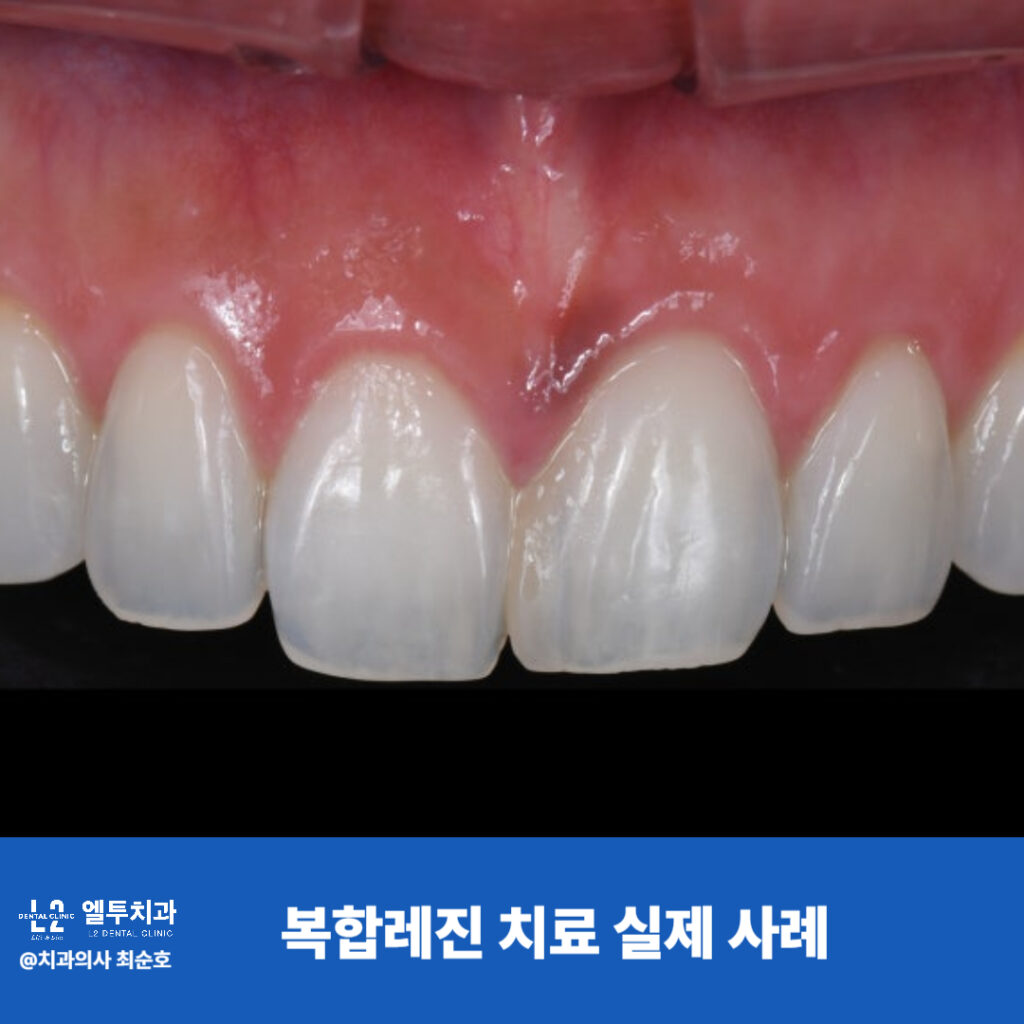 "앞니 복합레진 치료로 치아 대칭성과 색조가 개선된 실제 사례 이미지"
