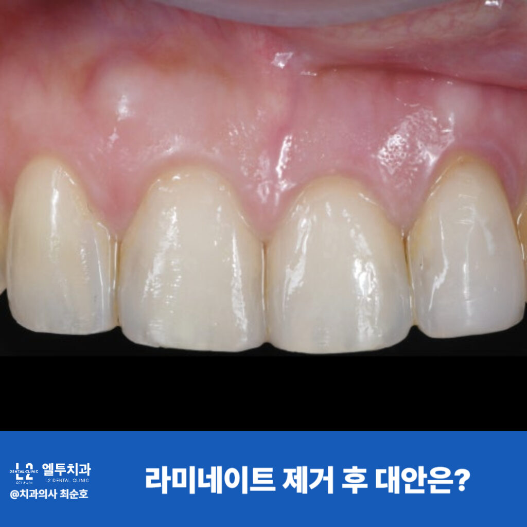 라미네이트 제거 후 레진으로 보강된 치아 전면