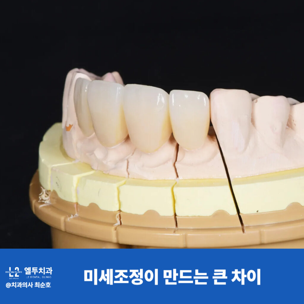 치아 모형을 통한 크라운 미세 조정