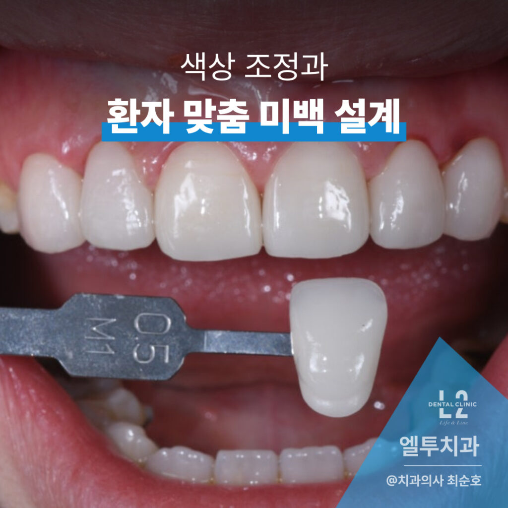 라미네이트 색상 비교를 위한 미백 팁 대조 이미지