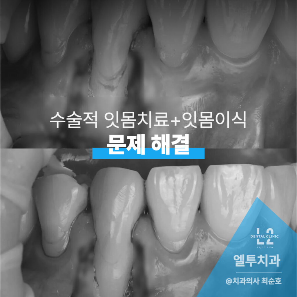 수술적 잇몸치료와 잇몸이식을 병행하여 문제를 해결한 사례