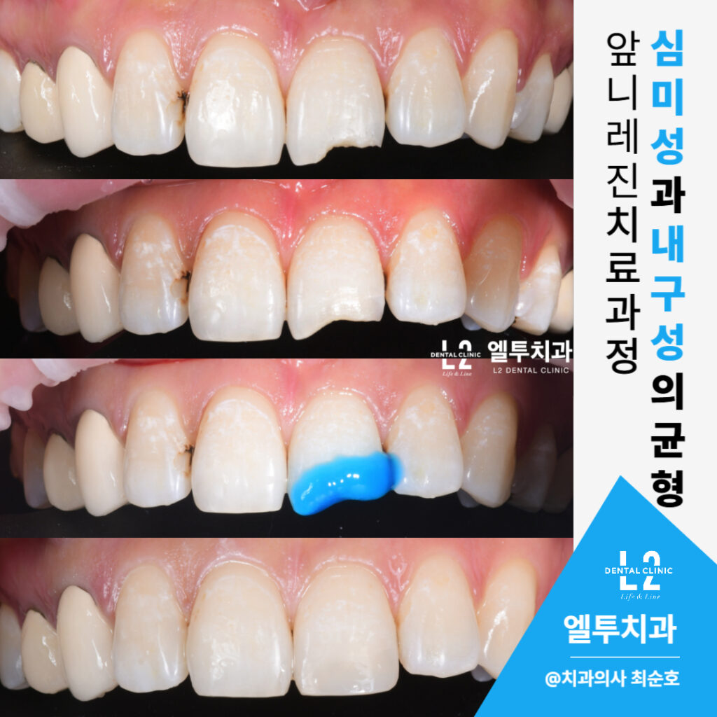 앞니깨짐과 충치를 정밀한 레진 적층 치료로 복원한 전체 치료 과정