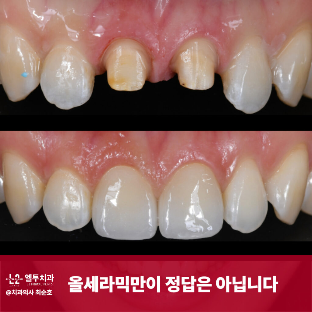 올세라믹 보철 치료 전 치아 삭제 후, 치료 완료 후 모습 비교