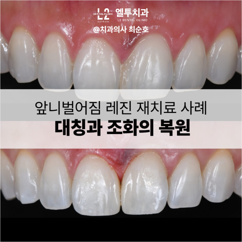 앞니벌어짐 레진 재치료 전후 비교, 비대칭 치아가 복원된 이미지