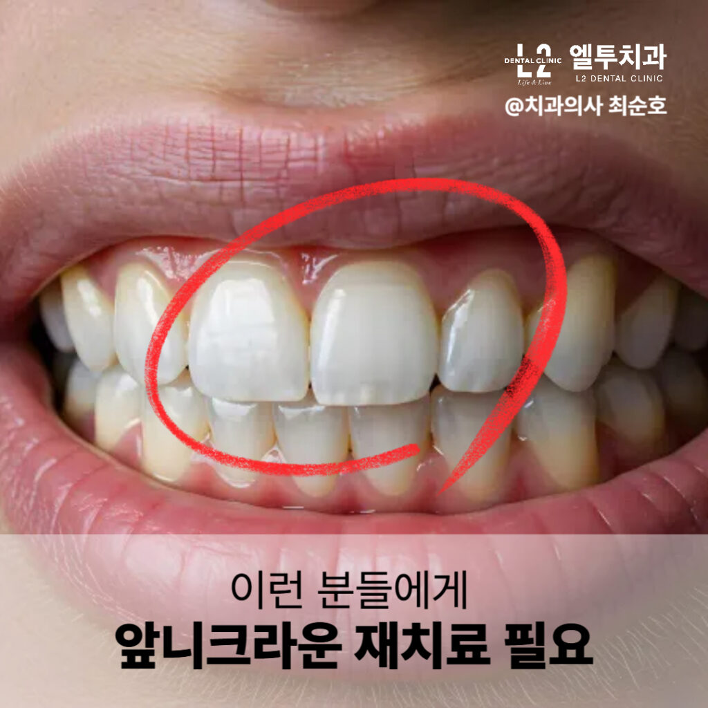 색상 이질감이 있는 크라운을 착용한 환자의 입