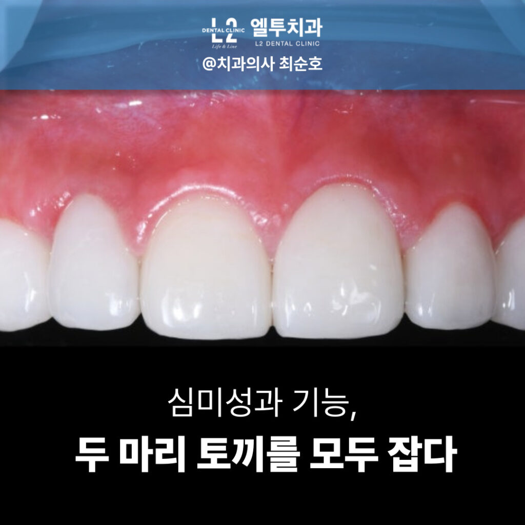 신경치료와 보철 치료 완료 후 심미적으로 개선된 앞니 모습