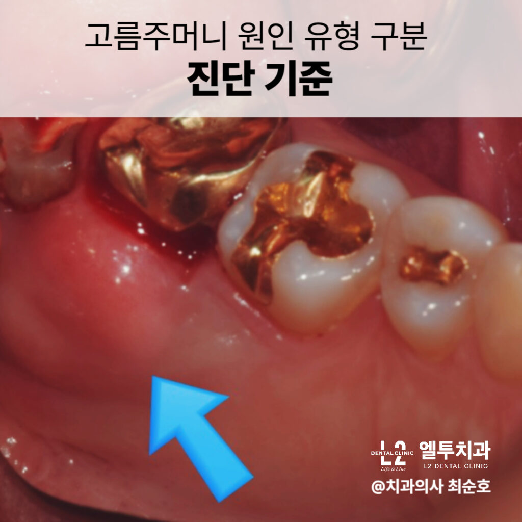 잇몸고름의 원인 유형을 진단하는 기준을 보여주는 이미지