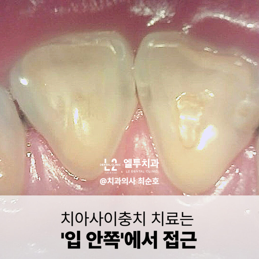 치아사이충치를 입 안쪽에서 접근해 치료한 구강 내 확대 이미지
