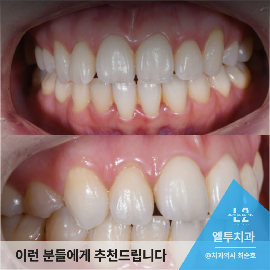 교정 전후 치아 정렬 비교 이미지