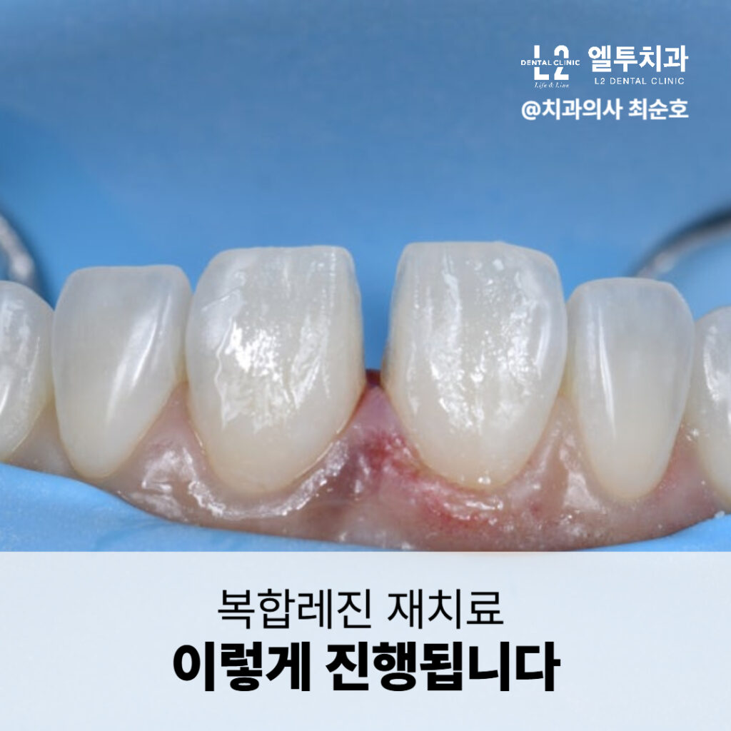 "복합레진 재치료 중 잇몸 주변 레진 제거 및 접착 전 처리 장면"